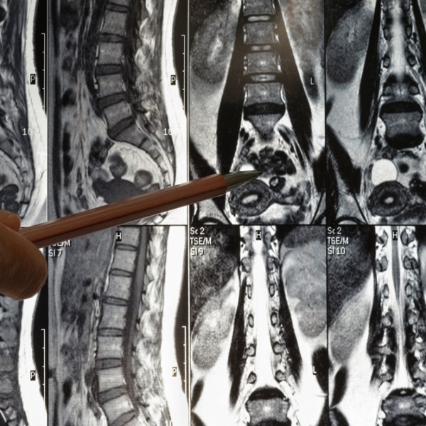 Spinal Cord & Orthopedic Injuries